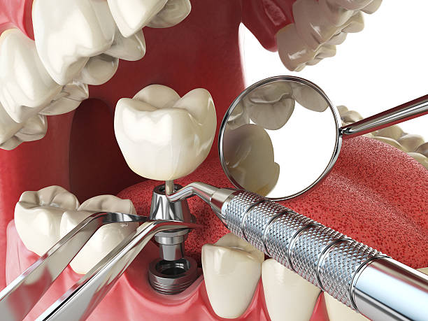 Best Emergency Dentist for Lost Fillings or Crowns in Ranchettes, WY