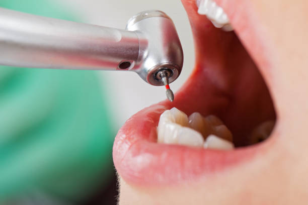 Best Emergency Dentist for Lost Fillings or Crowns in Ranchettes, WY